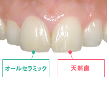 光の透過度が天然の歯に極めて近い