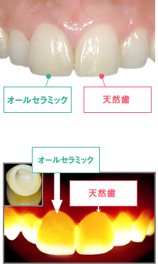 光の透過度が天然の歯に極めて近い