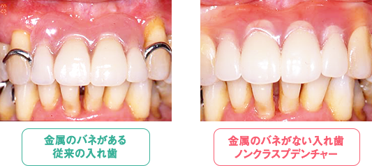金属のバネがない入れ歯ノンクラスプデンチャー
