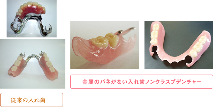 金属のバネがない入れ歯ノンクラスプデンチャー