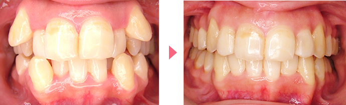 インビザライン・システムの治療