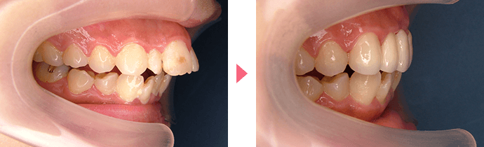 出っ歯の治療