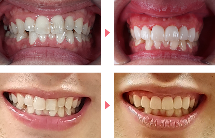 歯の変色の治療