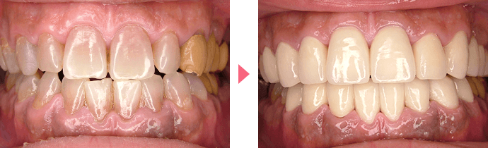 歯の変色の治療