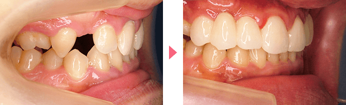 側切歯口蓋側転移・形態不全の治療