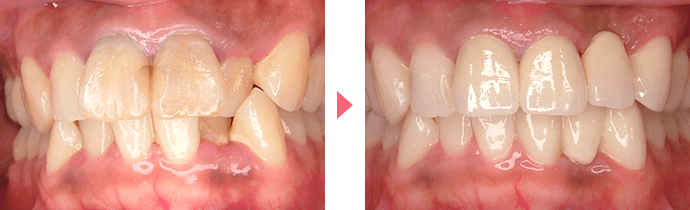 側切歯口蓋側転移・形態不全の治療