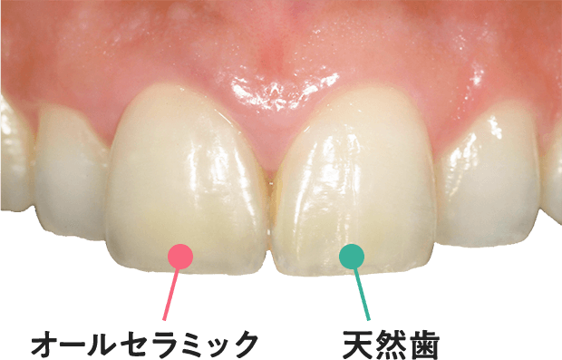 オールセラミックと天然歯の比較