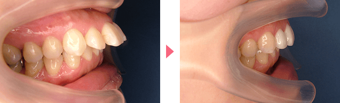 上顎前突の治療の例01