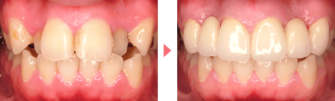 側切歯口蓋側転移の治療の例