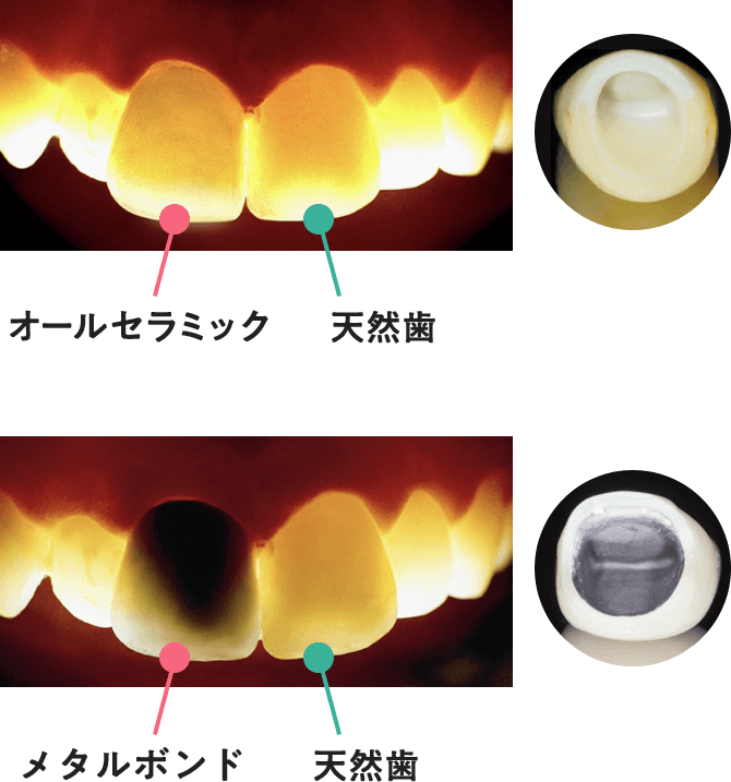 オールセラミックとメタルボンドの光の透過性の違い