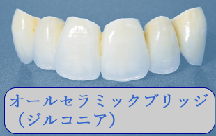 オールセラミックブリッジ