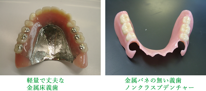 ノンクラスプデンチャー・金属床
