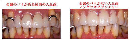 金属のバネがない入れ歯ノンクラスプデンチャー