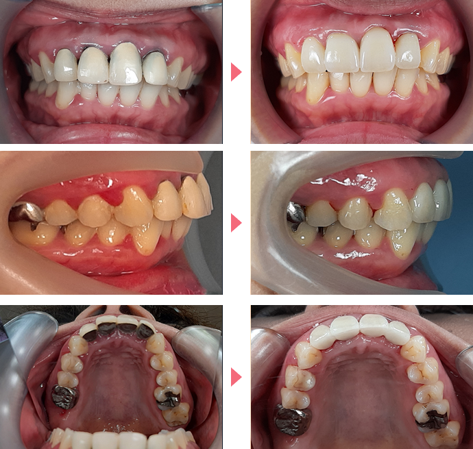 上顎前突の治療