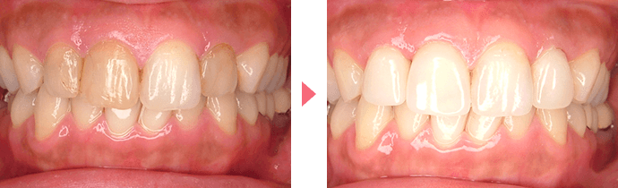 歯の変色の治療