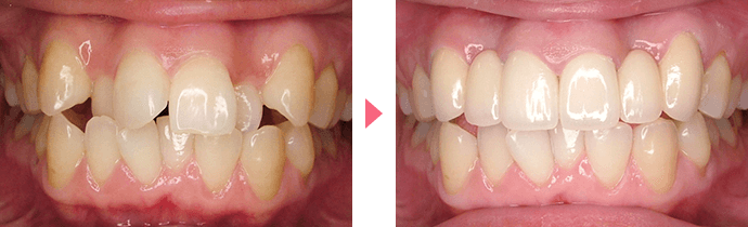 上顎前突の治療