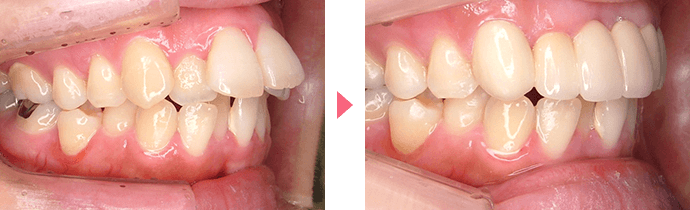 上顎前突の治療