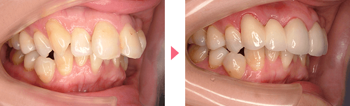 上顎前突の治療