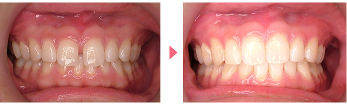 インビザライン・システムの治療