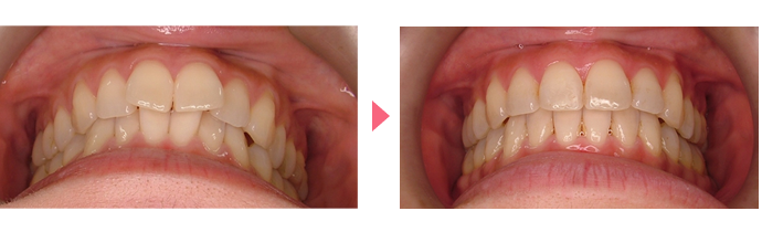 インビザライン・システムの治療